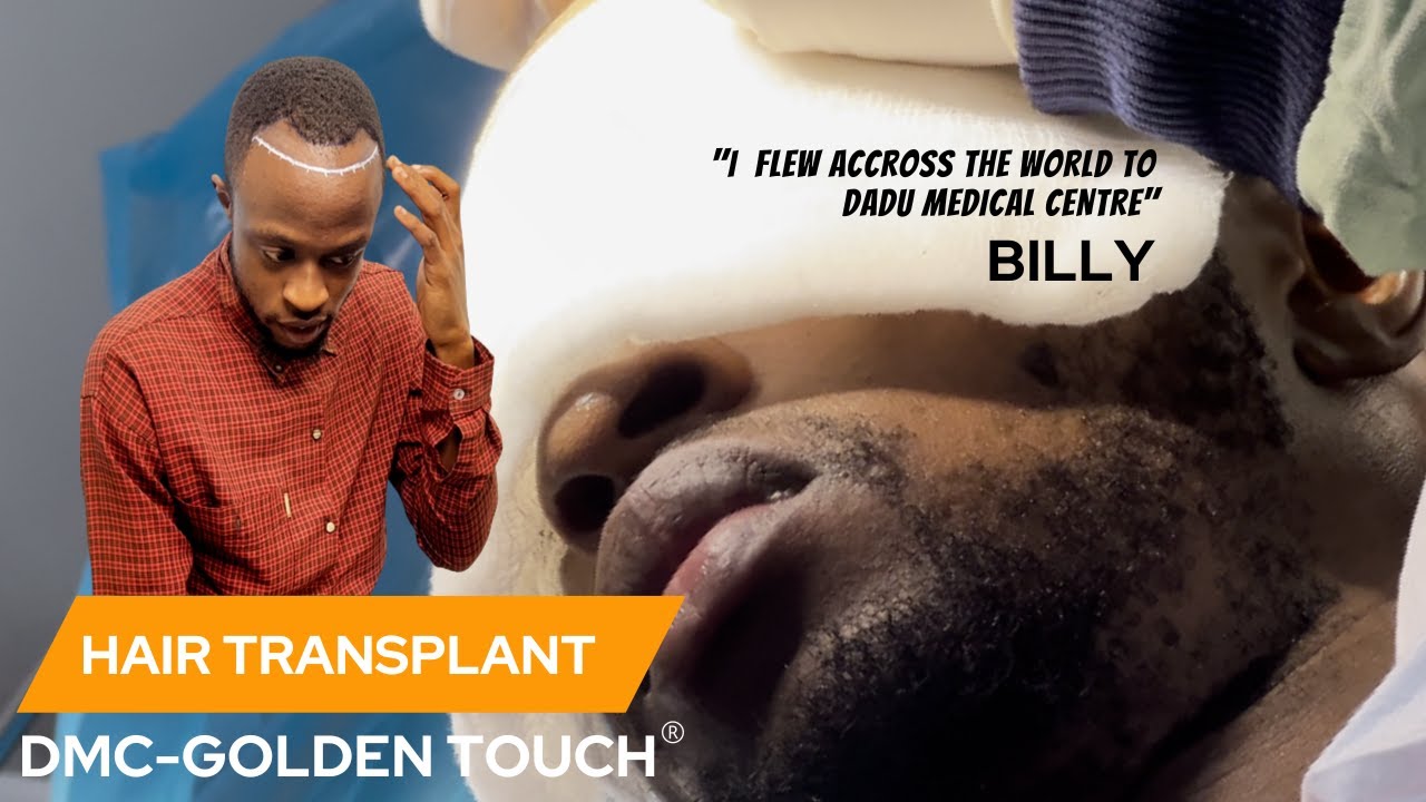 TANZANIA'S BILLY GOT HIS HAIR TRANSPLANT AT OUR CENTRE IN DELHI!| DADU MEDICAL CENTRE
