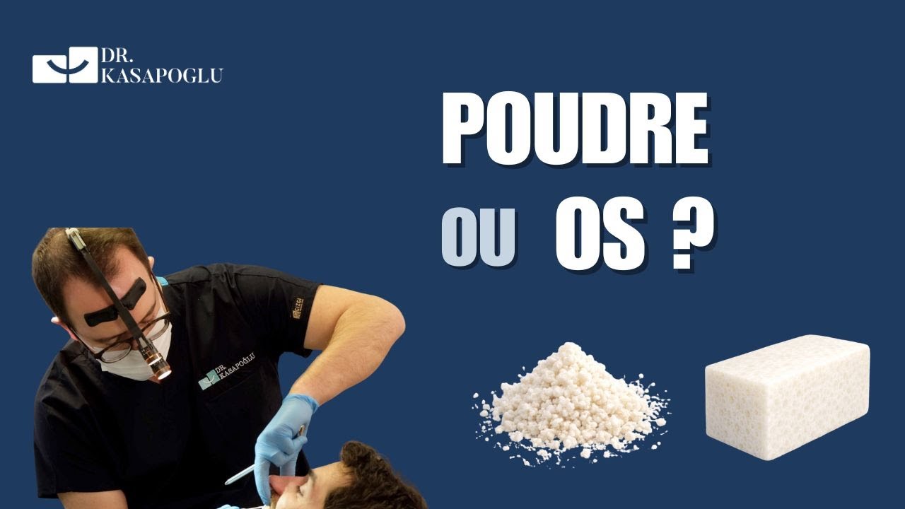 GREFFON OSSEUX : POUDRE OU VÉRITABLE OS ?