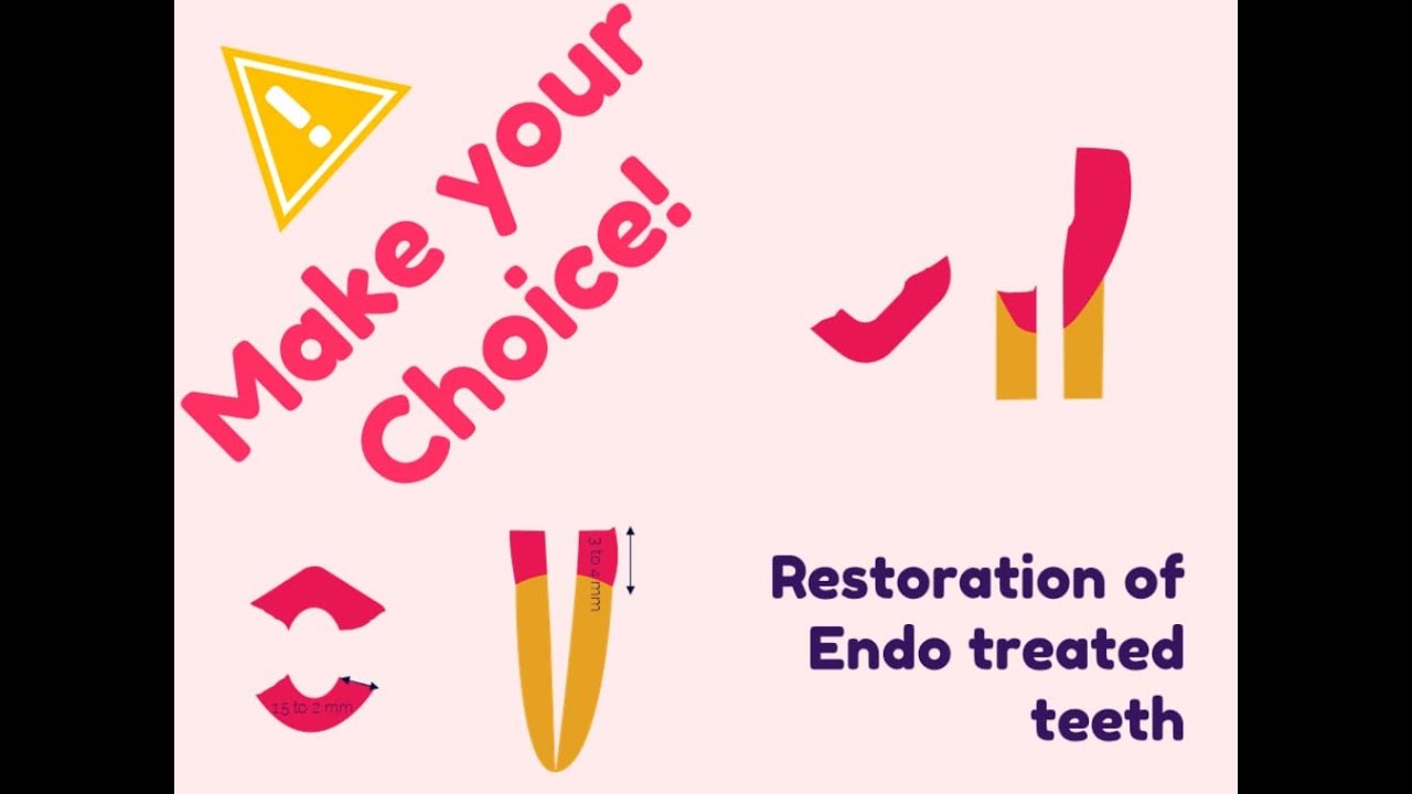 Video 3 : Restoration of endo-treated teeth (Selection critera )