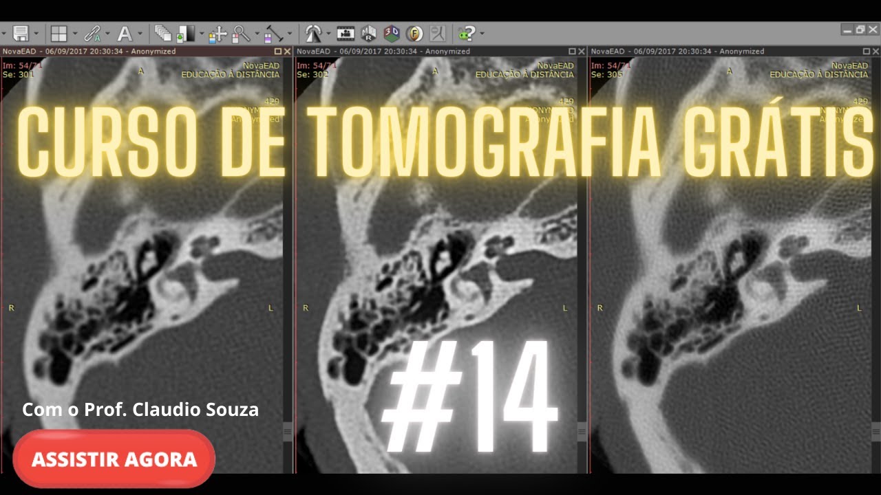 [CURSO TOMOGRAFIA GR&Aacute;TIS]  VOC&Ecirc; NA TOMOGRAFIA COM A NOVAEAD AULA 14