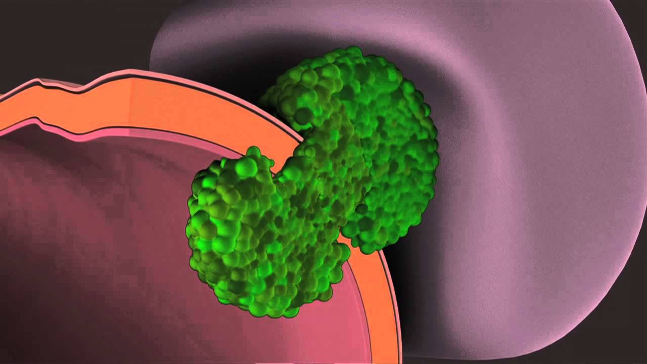How Cancer Spreads
