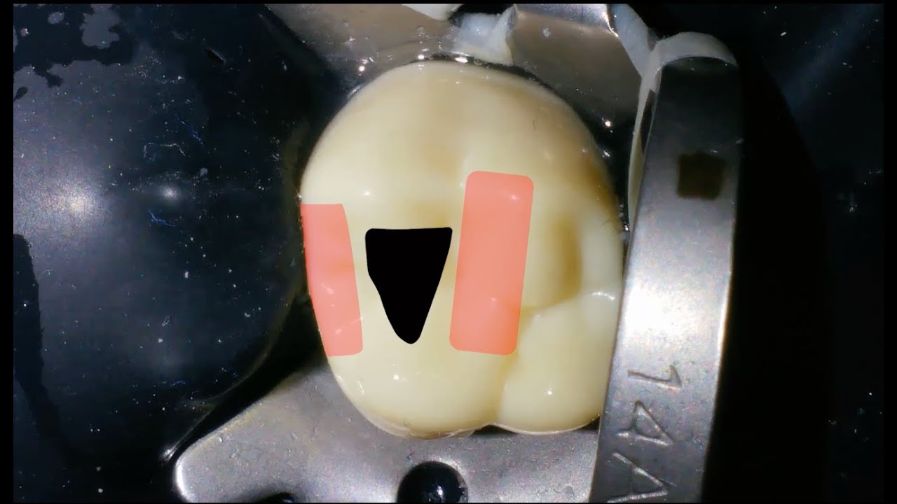 Maxillary First Molar Access Cavity Preparation