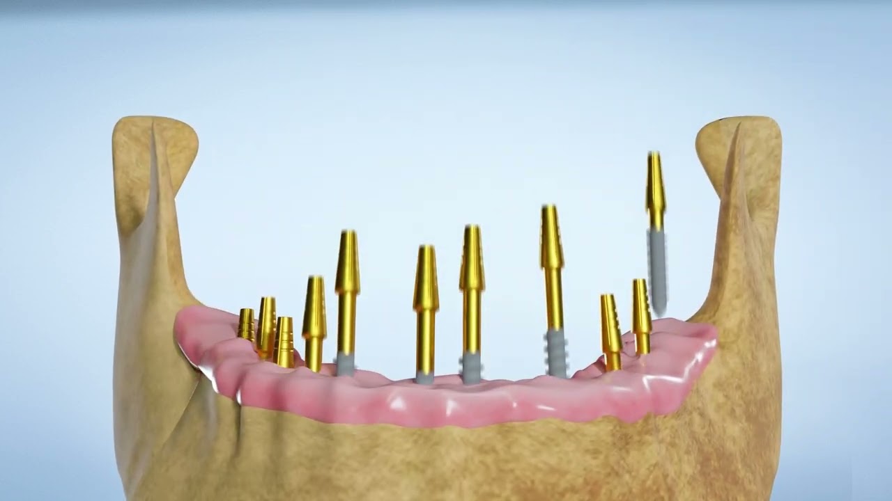 Sample dental implant 3D explainer video