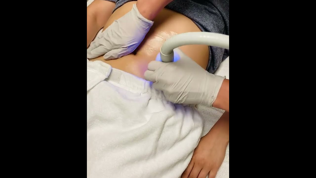 Cryoskin Treatments Near Me Golden Colorado for Stomach, Thighs and Back ☎️ 720-605-4282