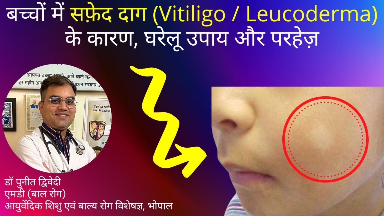 बच्चों में सफ़ेद दाग (Vitiligo / Leucoderma) के कारण, घरेलू उपाय और परहेज़ | डॉ पुनीत द्विवेदी