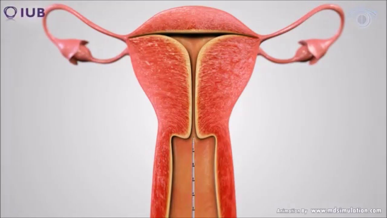 IUB SCu300 spherical IUD insertion procedure