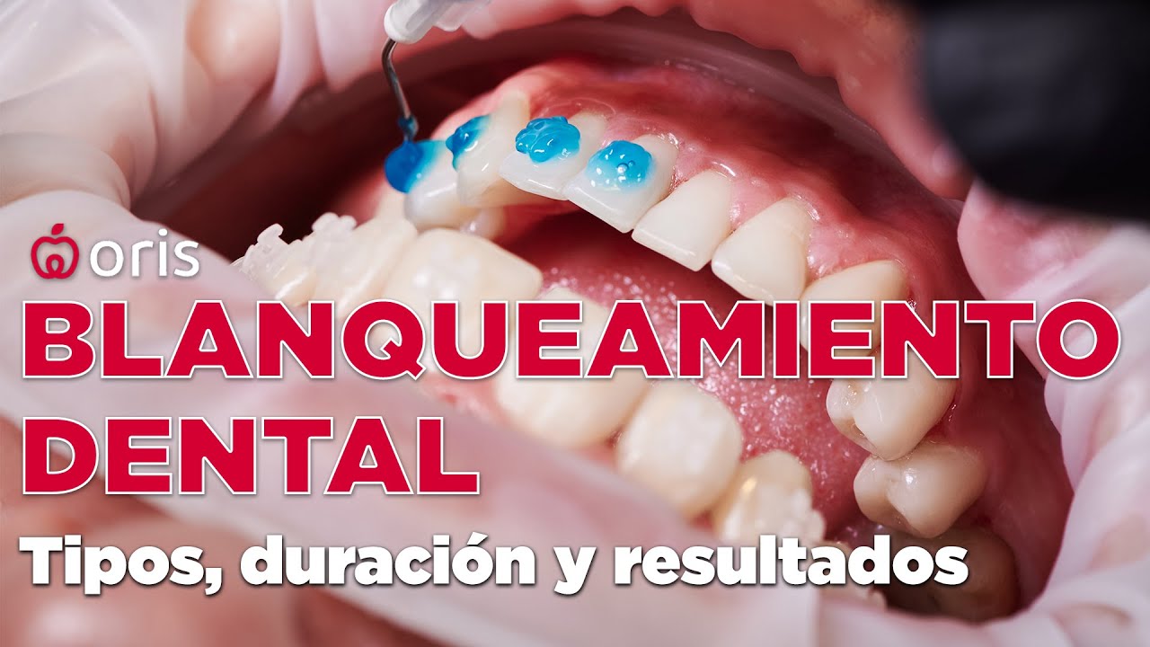 👉 Blanqueamiento dental: tipos, duración, seguridad y resultados