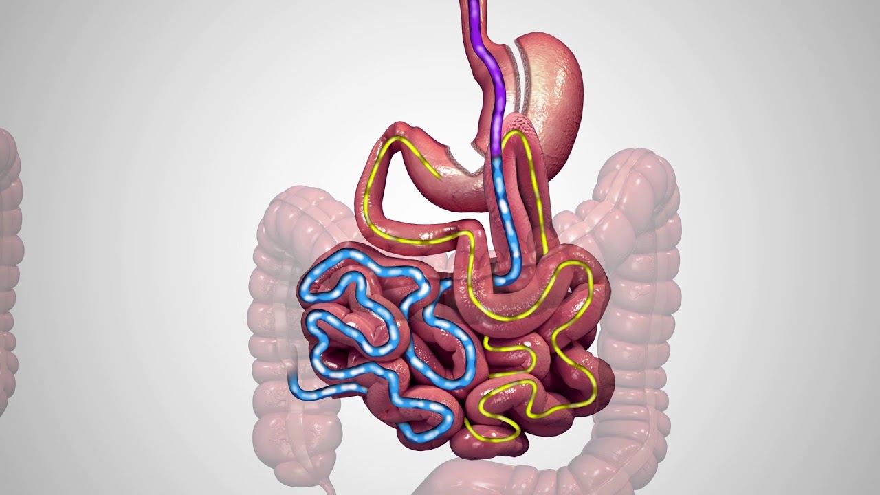One-Anastomosis Gastric Bypass (OAGB-MGB)