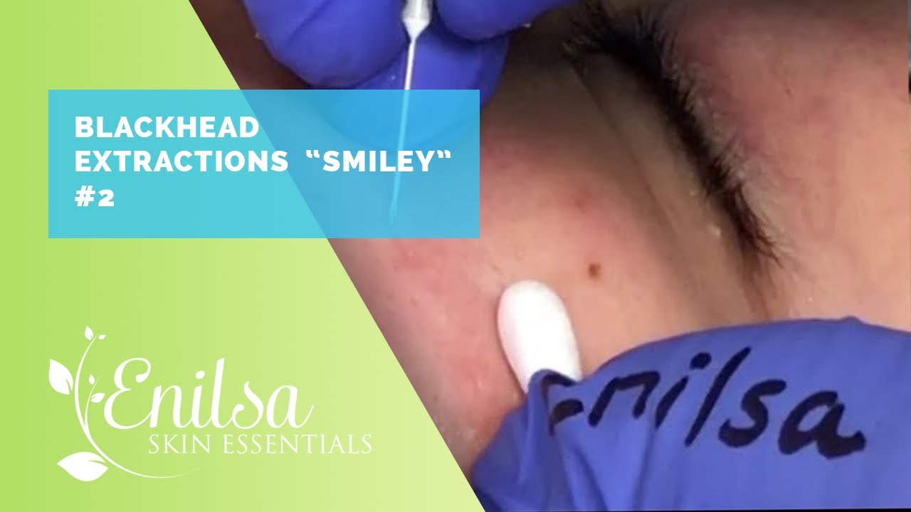 Extractions on 