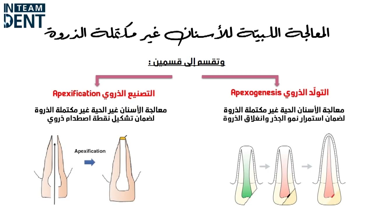 المعالجة اللبية للأسنان غير مكتملة الذورة