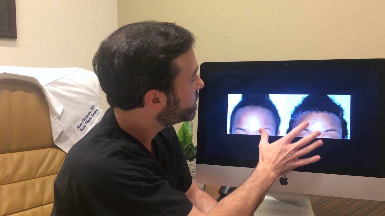 Hairline Lowering