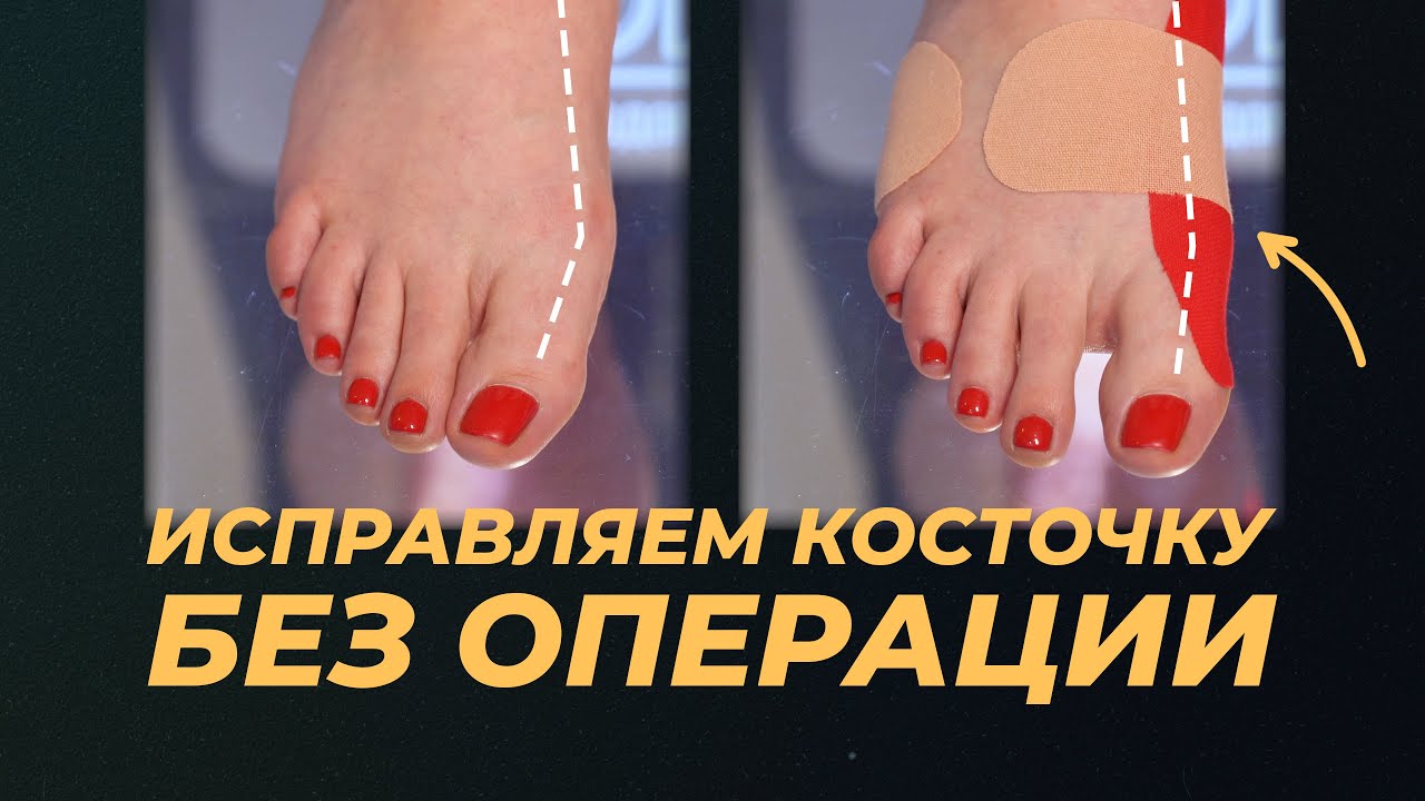 Тейпирование стопы при косточке / халюкс вальгус