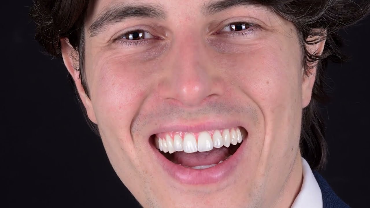 Prima e Dopo: ORTODONZIA INVISIBLE + FACCETTE DENTALI - La testimonianza di Alfredo