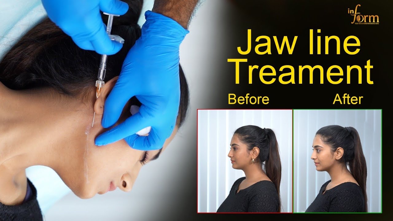 Jaw Line Treatment for Actress Rashi Singh By Dr.Dushyanth Kalva | Inform Clinics