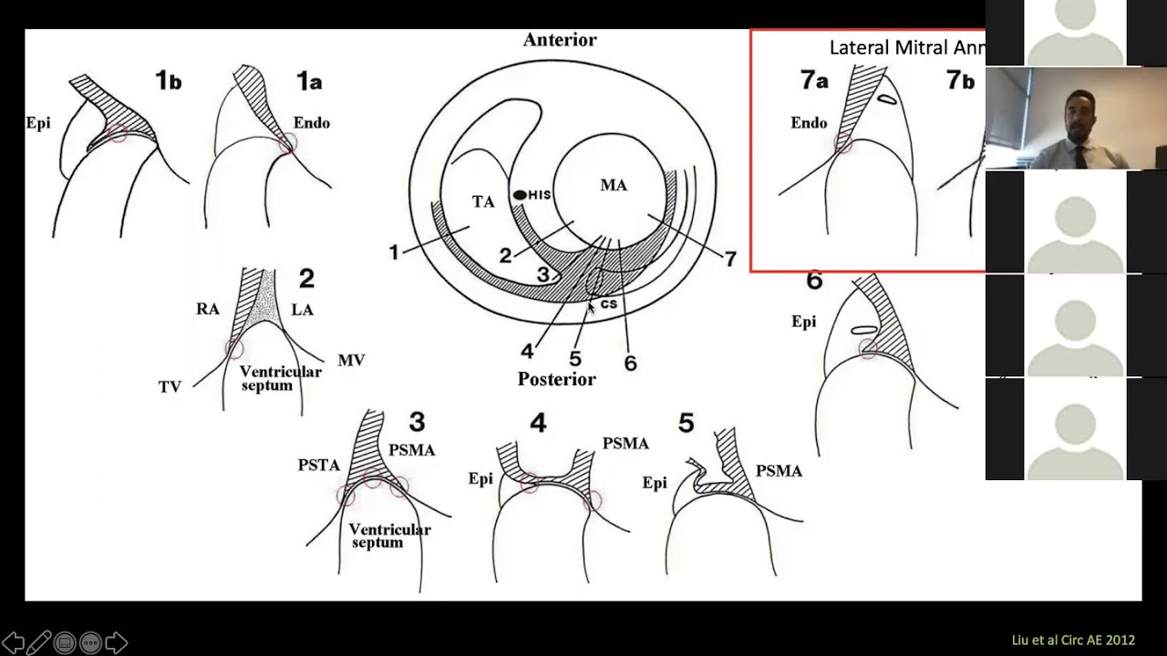 6 11 20 Ehdaie Electroanatomical considerations for the catheter ablation of accessory pathways