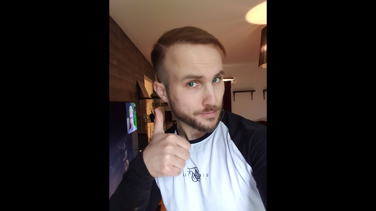 Hairtransplant at Clinicana in Istanbul Turkey - More than 1 year later.