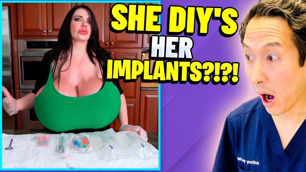 The LARGEST Implants in US! EXTREME Bodies Explained!