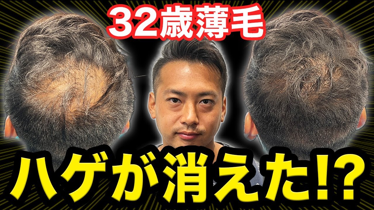 【30代薄毛】薄毛が目立たないヘアセットで大変身！