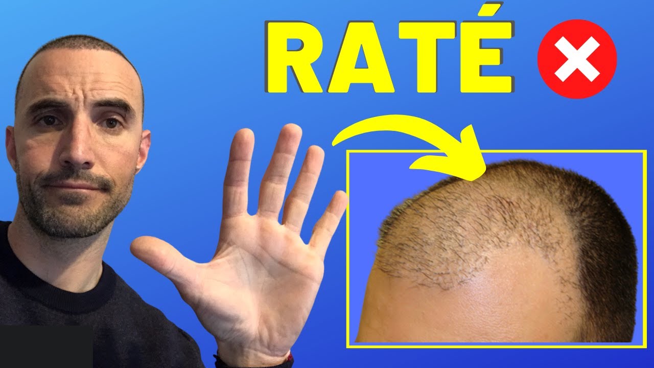 GREFFE DE CHEVEUX : LES 5 RAISONS POUR LESQUELLES ÇA RATE ! 💥🪓