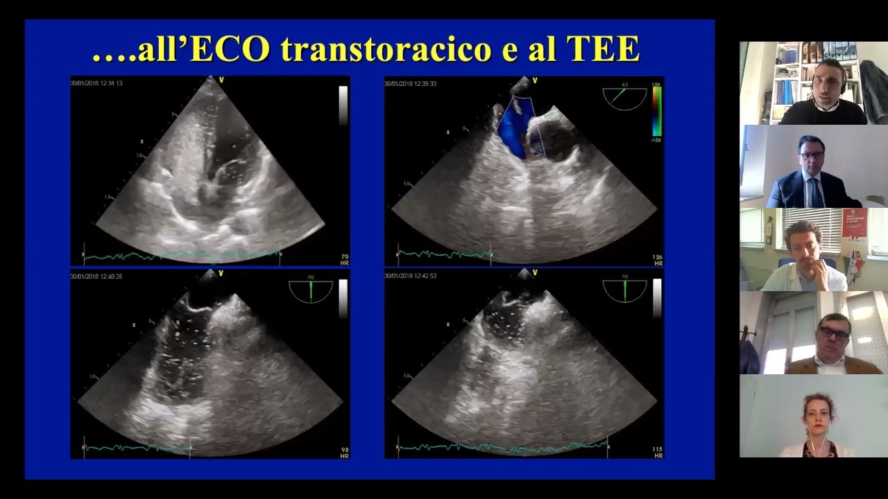 IL RUOLO DELL’ECOCARDIOGRAFIA NELLE CARDIOPATIE CONGENITE: COSA SAPPIAMO