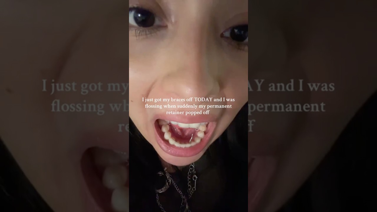 The Truth About 'Permanent' Retainers 😬