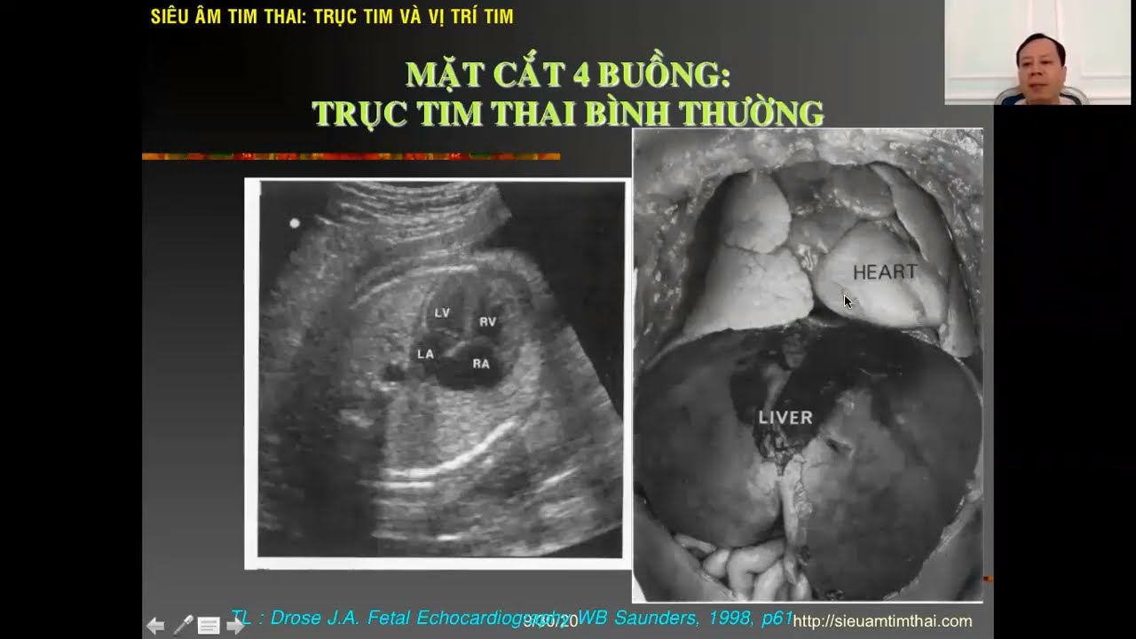 29 Siêu âm tim thai - các mặt cắt cơ bản trong siêu âm tim thai - TS.BS. Lê Kim Tuyến