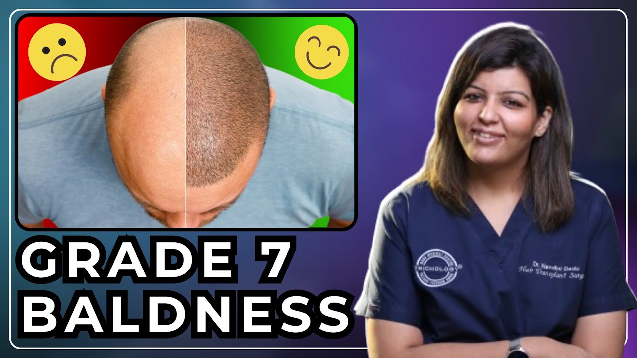 Grade 7 Baldness: Best Hair Transplant Strategy Guide