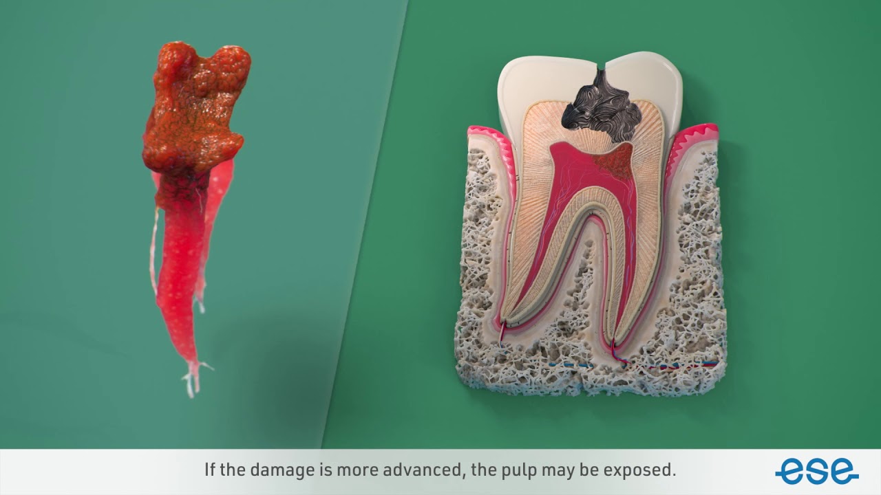 ESE Video - VITAL PULP TREATMENT