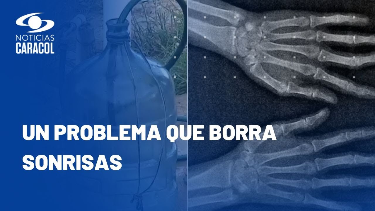 Agua con flúor en corregimiento del Huila: dientes manchados y extremidades torcidas prenden alarmas