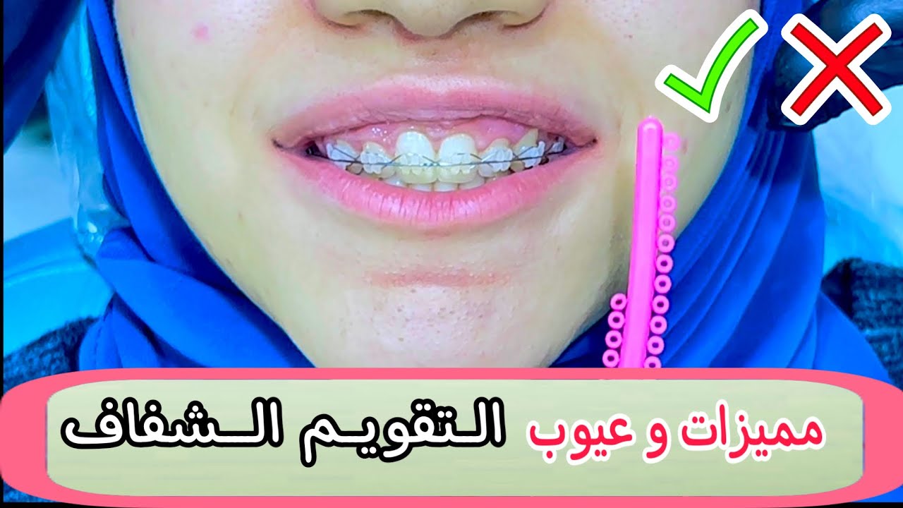 تقويم الأسنان الشفاف | ألوان التقويم | مميزات و عيوب التقويم الشفاف | غلق المسافات بين الاسنان