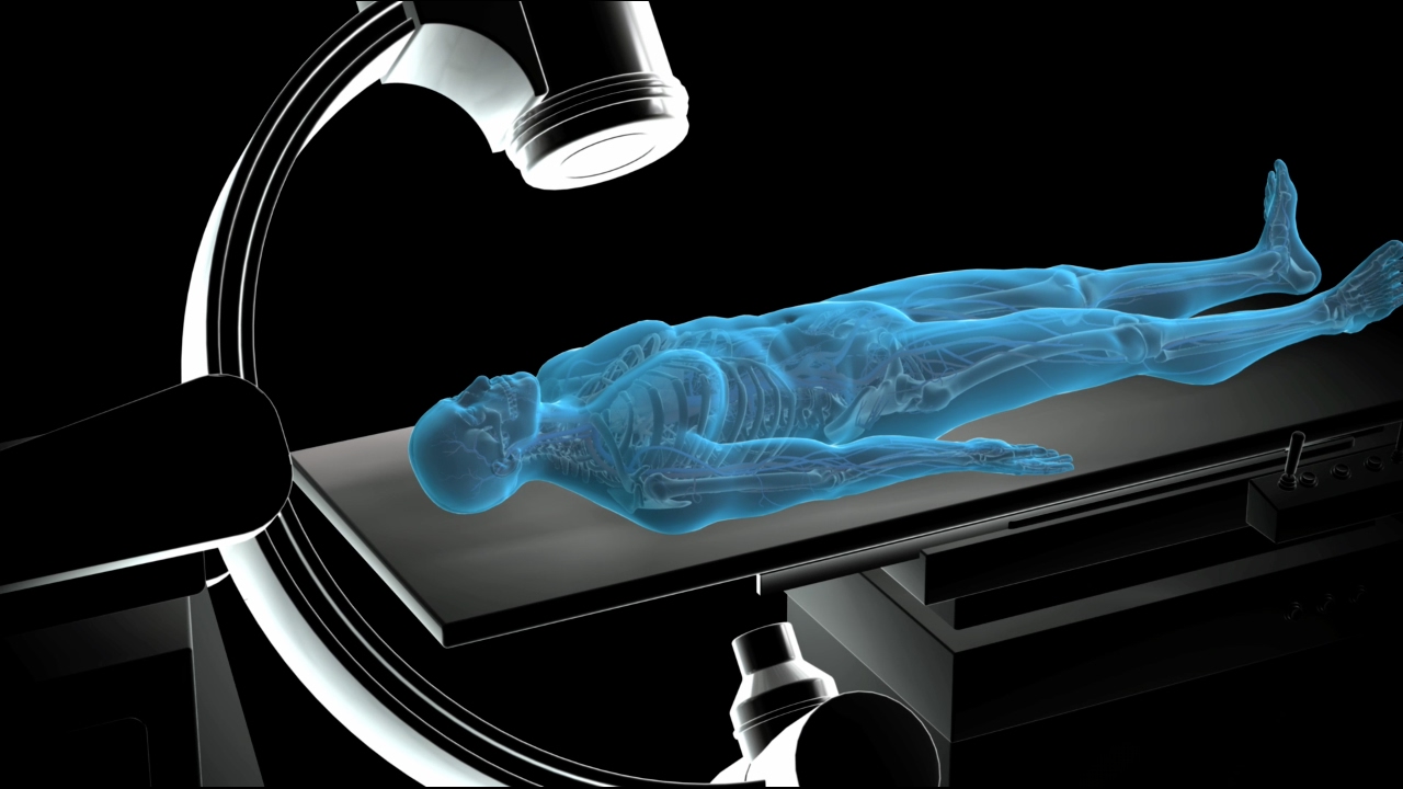Non Cardiac Percutaneous Transluminal Angioplasty | NCPTA | Nucleus Health