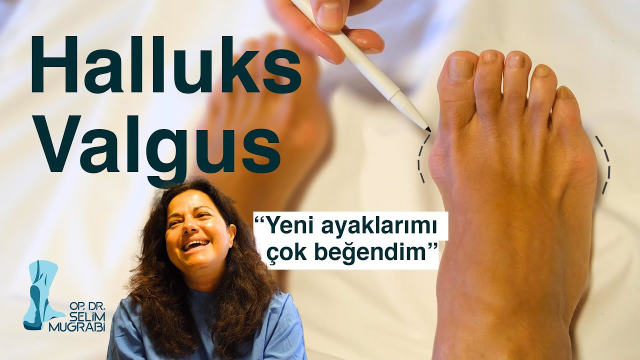 Yeni Ayaklarımı Çok Beğendim! (Halluks Valgus Ameliyatı)  / Op. Dr. Selim Muğrabi