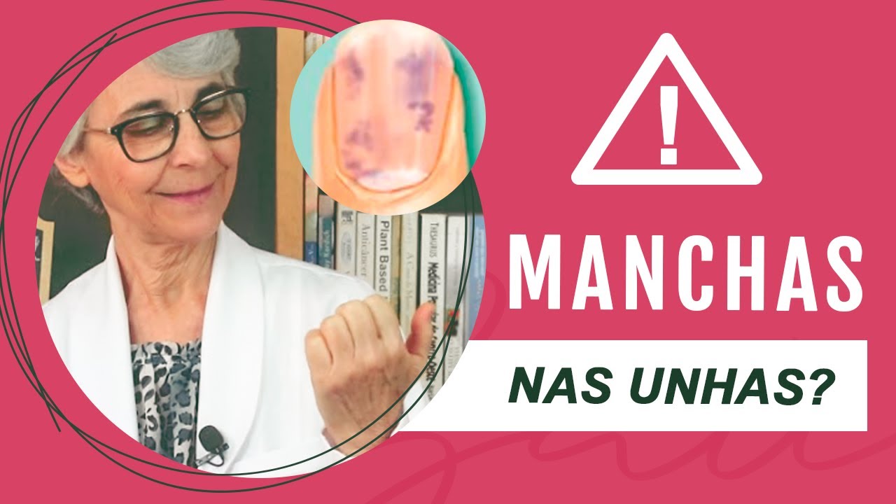 Manchas nas unhas, ligue o sinal de alerta!