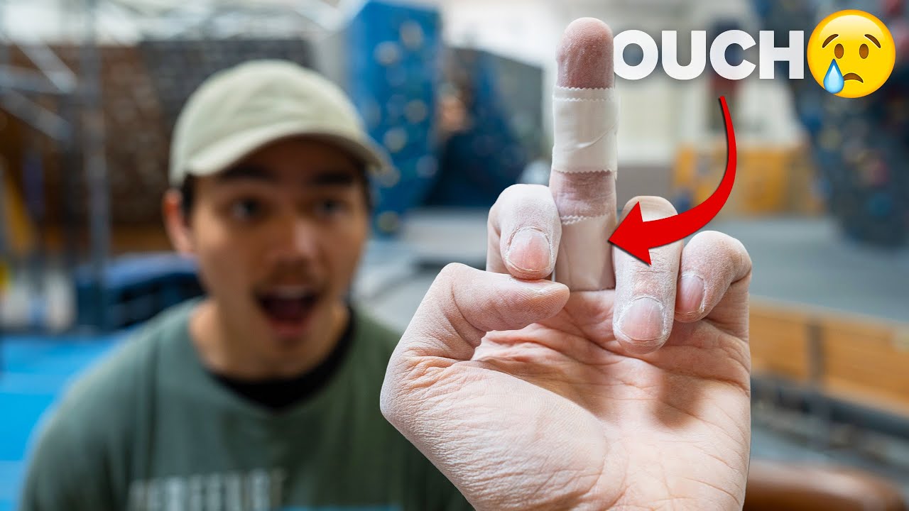 Finger Injuries - My experience w/ an A2 Pulley Sprain