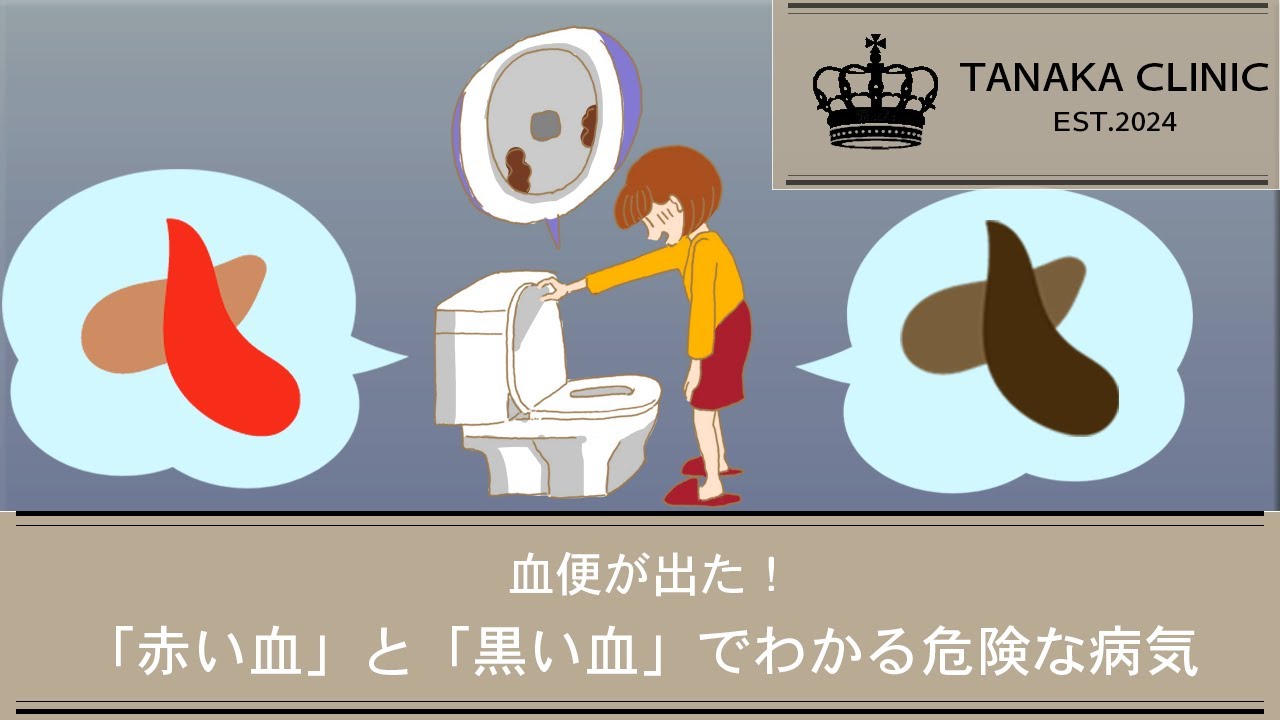 35　血便が出た！「赤い血」と「黒い血」でわかる危険な病気｜たなか内科クリニック