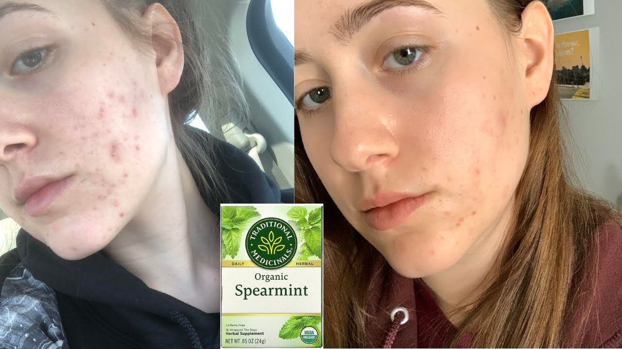 I drank spearmint tea for 4 months to clear my cystic hormonal acne