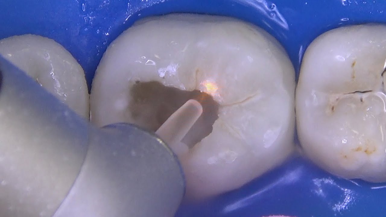 Preparo cavitário com laser de alta potência Er:YAG (Tooth preparation with high power laser Er:YAG)