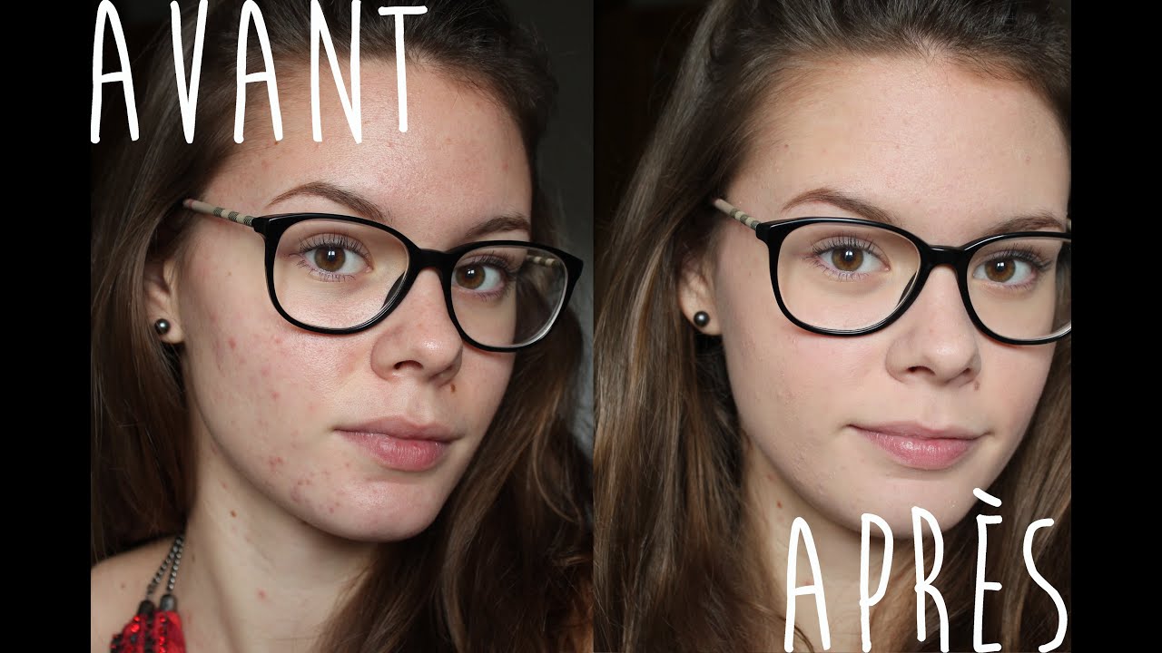 Routine teint peau acnéique, à imperfections, mixte à grasse !