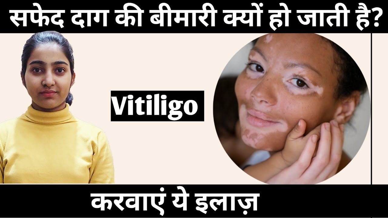 सफेद दाग की बीमारी क्यों हो जाती है?|करवाएं ये इलाज़|Vitiligo causes, symptoms and treatment|