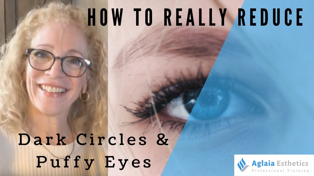 HOW TO GET RID OF DARK CIRCLES FAST!