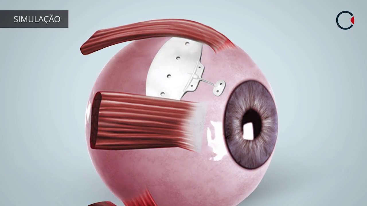 Tratamentos para o Glaucoma: TUBO DE DRENAGEM.