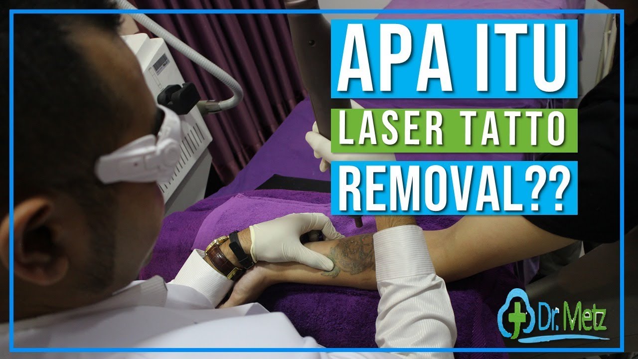 Apa itu Laser tatto removal ??