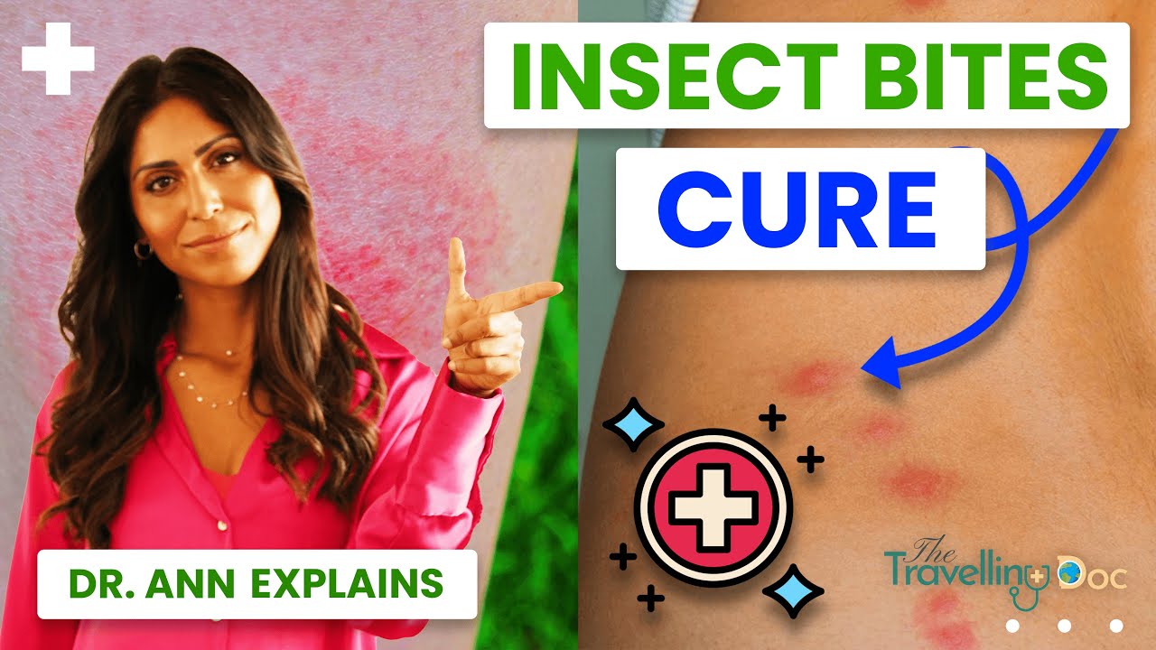 Insect Bites: Treatment, Home Remedies & When to See a Doctor (Doctor Explains)