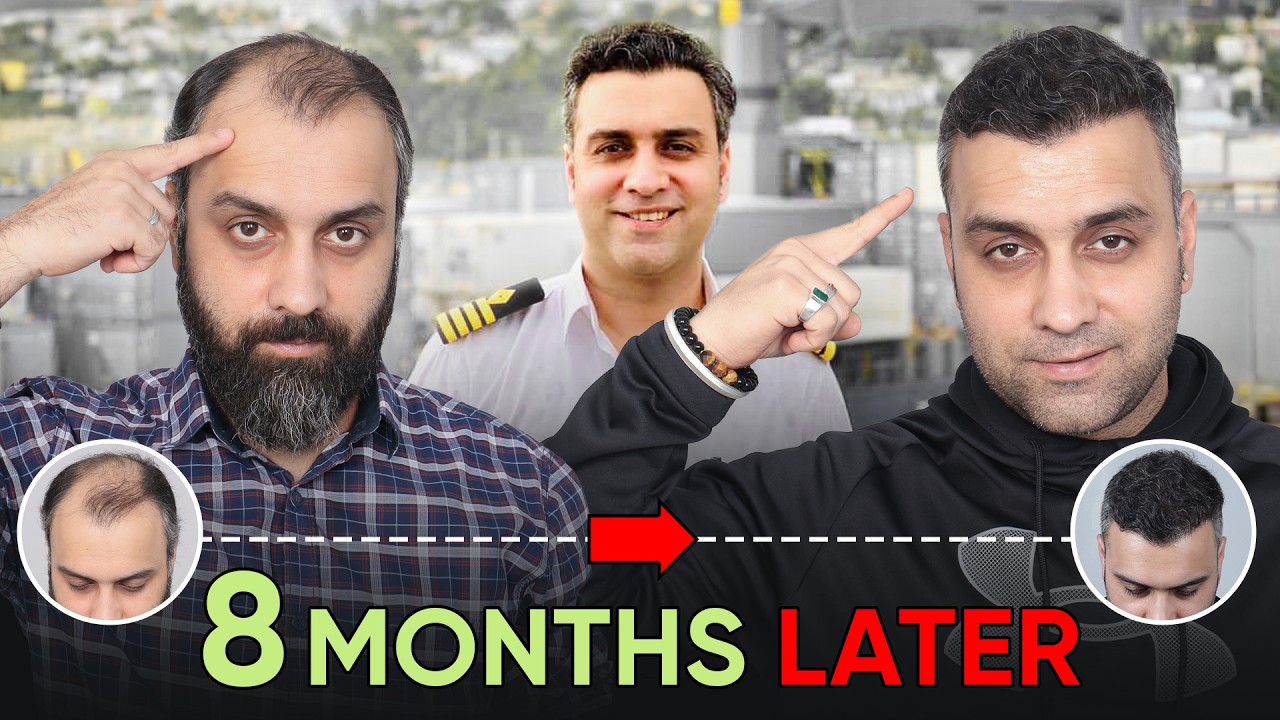 Hair Transplant in Nagpur (HX-ATYR) | Best Results & Cost of Hair Transplant in Nagpur.