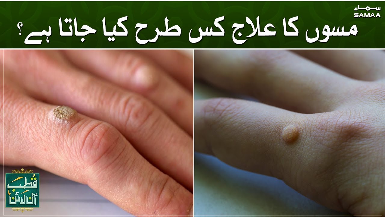 Mason ka ilaaj kis tarhan kiya jata hai ? | Qutb Online | SAMAA TV