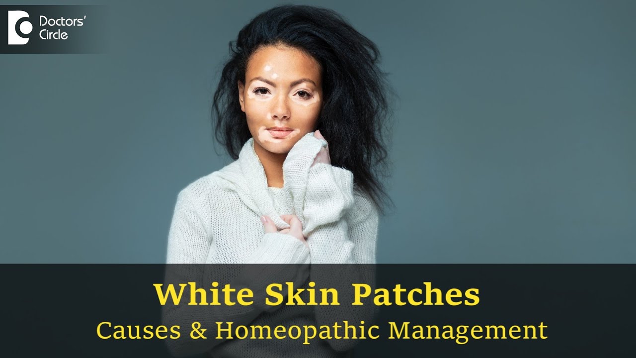 White Skin patch | Vitiligo | Leucoedema- Homeopathic Cure-Dr. Sahana Ramesh Tambat| Doctors' Circle