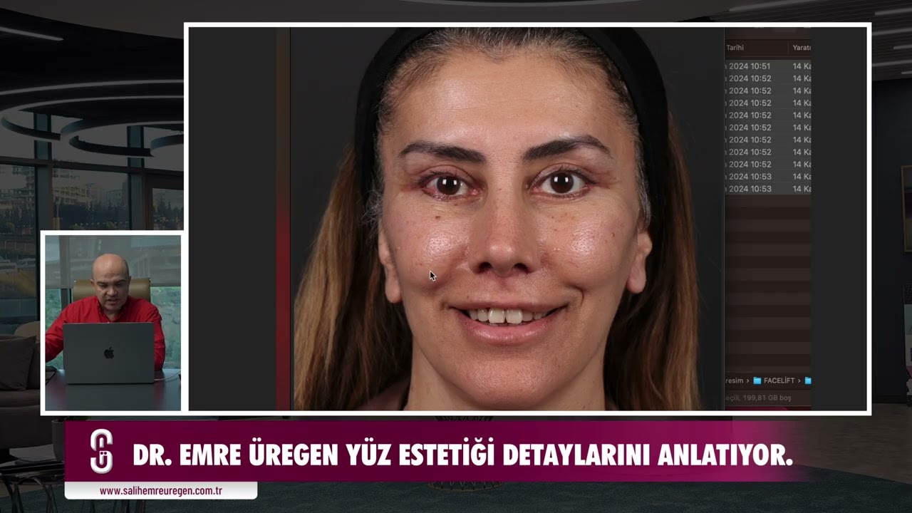 Yüz Estetiğinden Sonra 1,5 Ayda Neler Değişir? (Beklenen ve Beklenmeyenler)