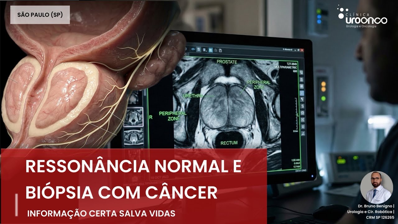 PSA Alto e RESSONÂNCIA da PRÓSTATA Limpa: O Erro que pode custar o diagnóstico precoce