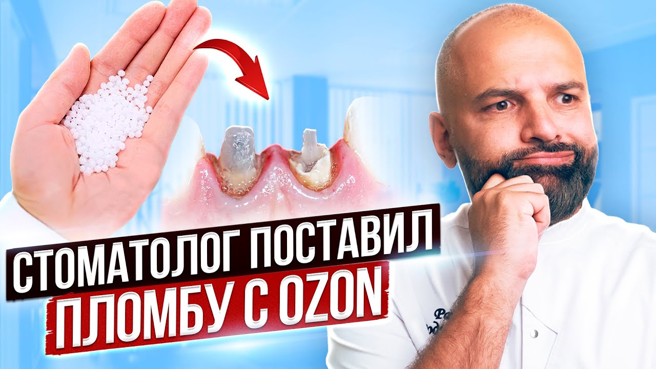 Самый популярный товар на Ozon Зубная пломба - виниры. Стоматолог проверил пломбу - виниры с ОЗОН