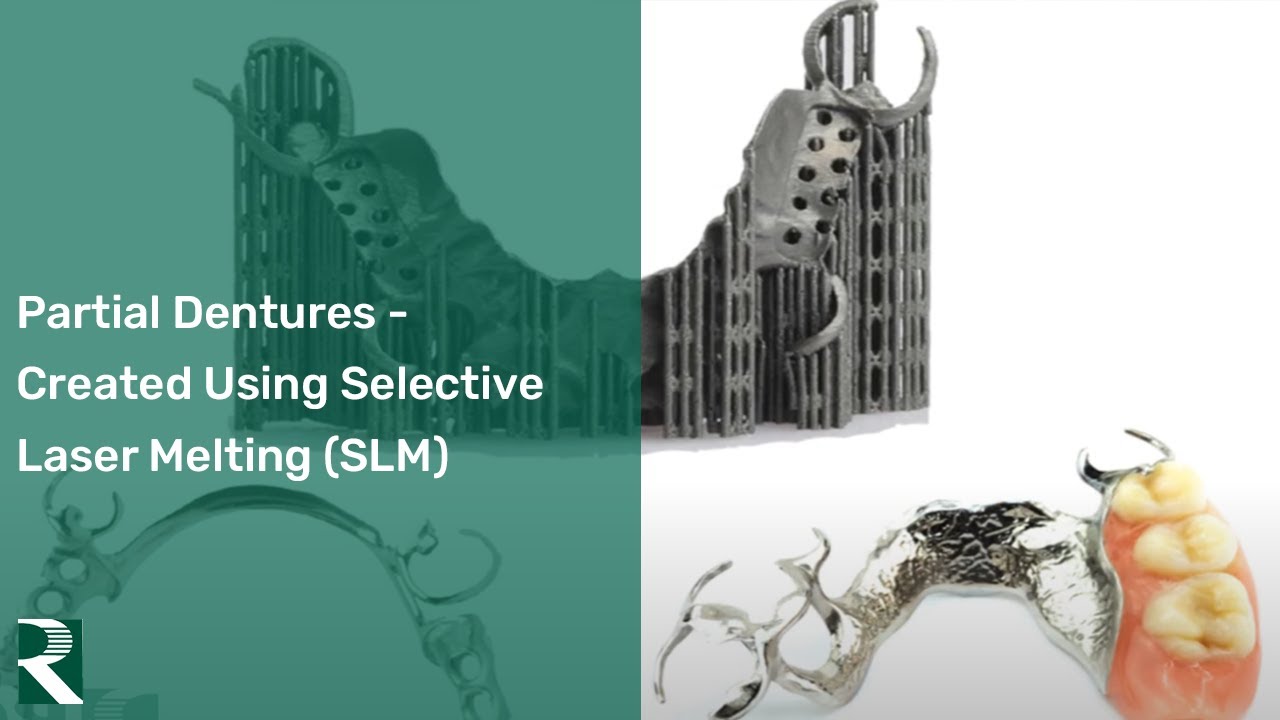 Partial Dentures - created using Selective Laser Melting (SLM) Technology